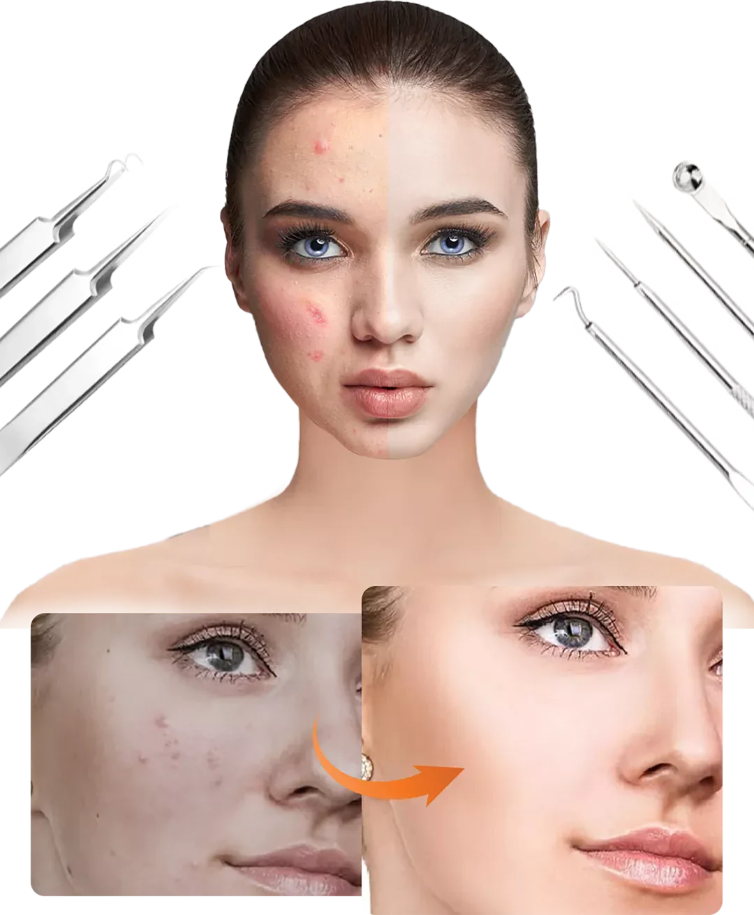 Blackhead Remover Set PureSkinX | Precise & Hygienic | Stainless Steel Tools for Clear Skin