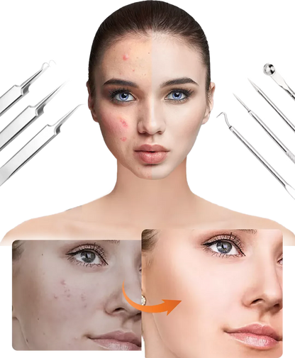 Blackhead Remover Set PureSkinX | Precise & Hygienic | Stainless Steel Tools for Clear Skin