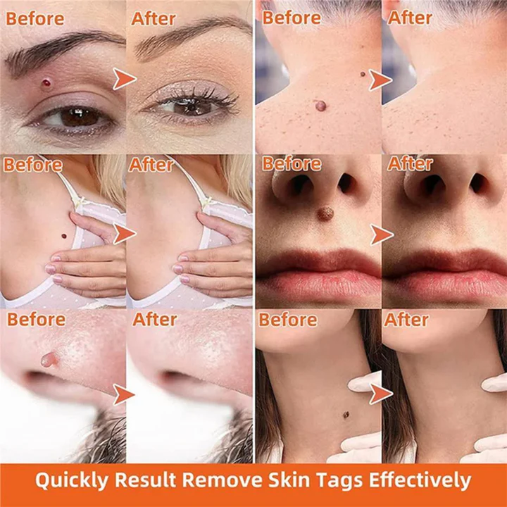 DermaClear Skin Tag Remover | Pain-Free Use | Compact & Hygienic | For Men & Women