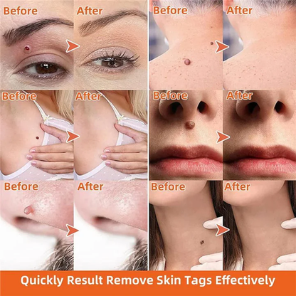 DermaClear Skin Tag Remover | Pain-Free Use | Compact & Hygienic | For Men & Women