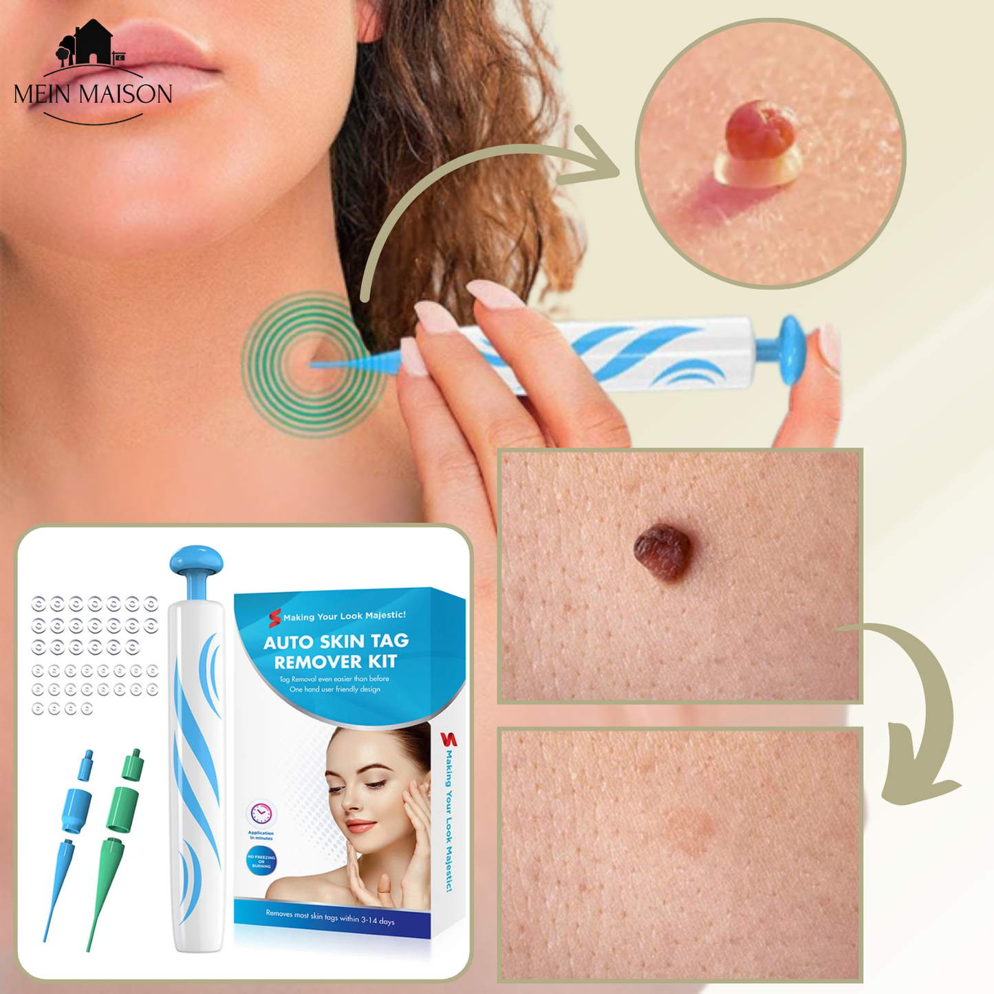 DermaLinx Wart Remover | Pain-Free Removal of Warts & Moles | For Home Use | No Surgery