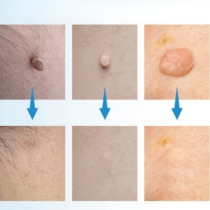 WartAway – Natural Wart Remover