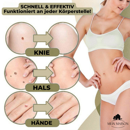 DermaLinx Wart Remover | Pain-Free Removal of Warts & Moles | For Home Use | No Surgery