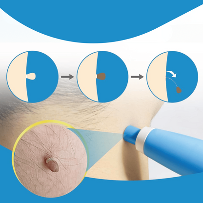 WartAway – Natural Wart Remover