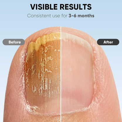 FungiGuard – Achieve clear, healthy nails in just 7 minutes a day