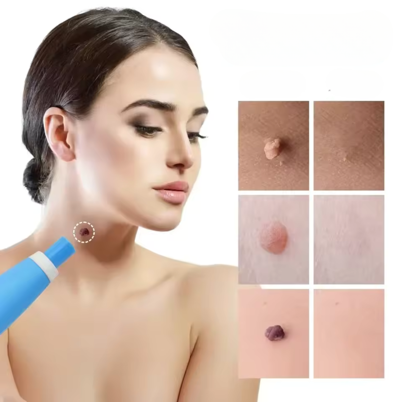 WartAway – Natural Wart Remover