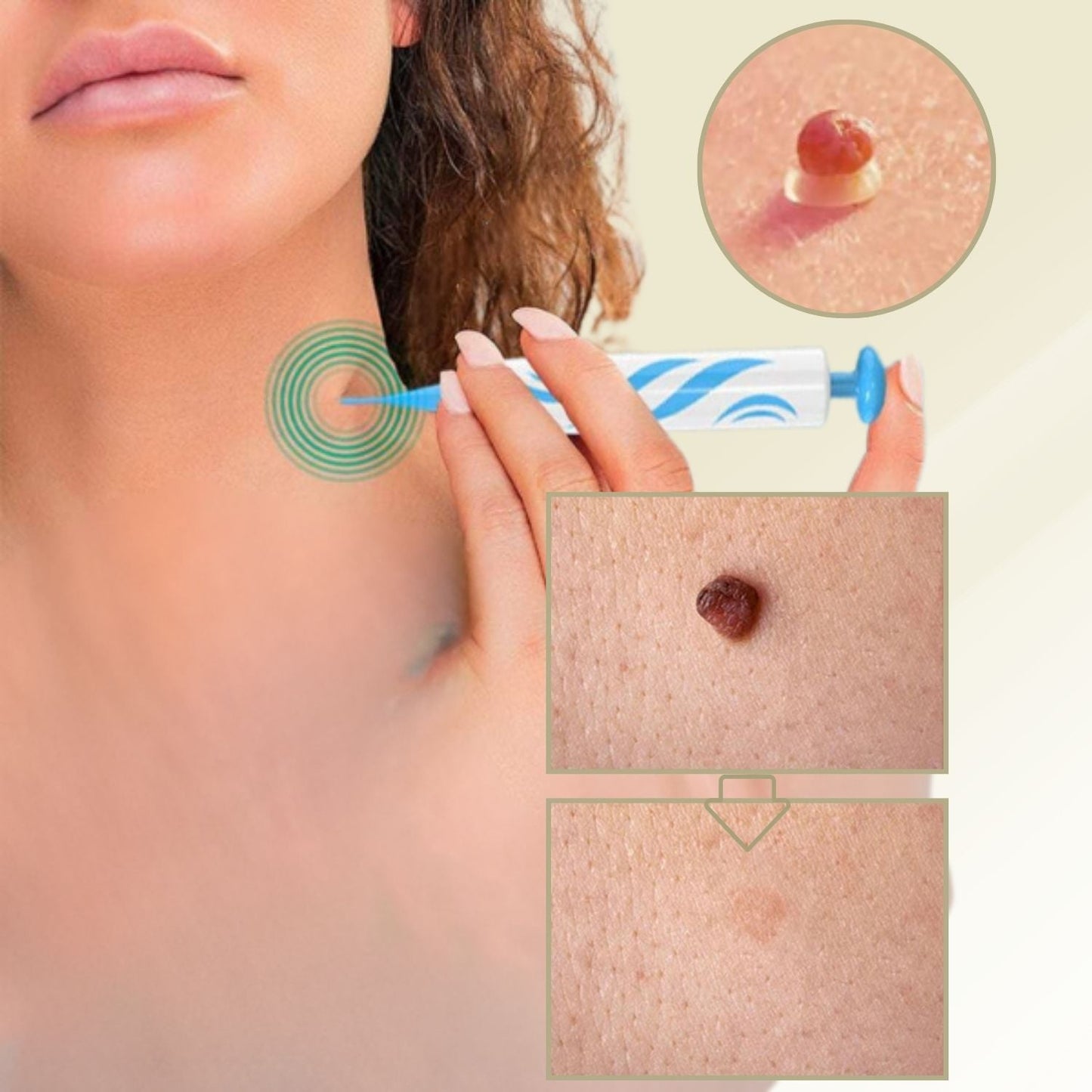 DermaLinx Wart Remover | Pain-Free Removal of Warts & Moles | For Home Use | No Surgery