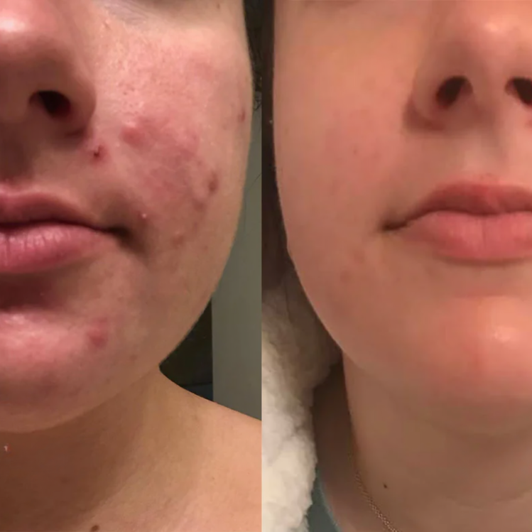 Buy 1 Get 1 Free | DermCare SkinGlow – Achieve perfectly smooth skin!